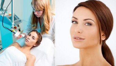 The essence of the laser skin rejuvenation procedure.