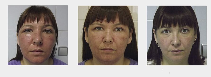swelling after fractional rejuvenation